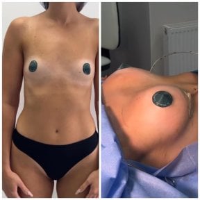 Before and after breast lift results at Dmytrii Homola Clinic, visible breast contour improvement