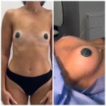 Before and after breast lift results at Dmytrii Homola Clinic, visible breast contour improvement