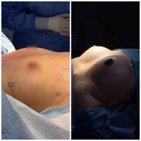 Before and after breast lift results at Dmytrii Homola Clinic, visible breast contour improvement