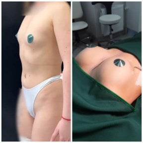 Before and after breast lift results at Dmytrii Homola Clinic, visible breast contour improvement