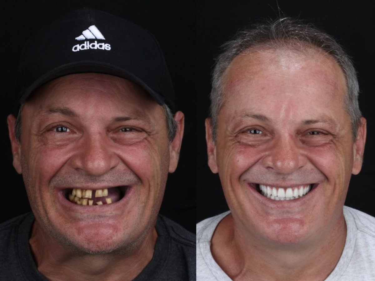 Resultados antes y después de implantes All-on-6 en European Valley Health, restauración de sonrisa