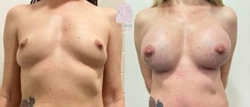 Foto prima e dopo di Rinoplastica realizzate dal Dott./Dott.ssa 