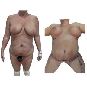 Before and after mommy makeover results at Hospital de la Familia, body contour improvement