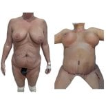Before and after mommy makeover results at Hospital de la Familia, body contour improvement