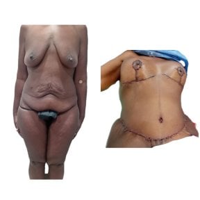 Before and after mommy makeover results at Hospital de la Familia, body contouring improvement