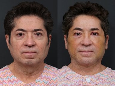 Результаты до и после deep plane SMAS лифтинга в RNWOOD Plastic Surgery, омоложение лица