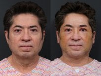 Результаты до и после deep plane SMAS лифтинга в RNWOOD Plastic Surgery, омоложение лица