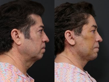 Результаты до и после deep plane SMAS лифтинга в RNWOOD Plastic Surgery, подтяжка линии челюсти