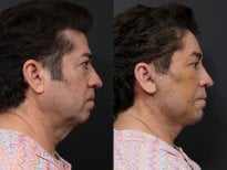 Результаты до и после deep plane SMAS лифтинга в RNWOOD Plastic Surgery, подтяжка линии челюсти