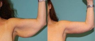 Before and after Vaser liposuction arm contouring results at ID Clinic Bangkok