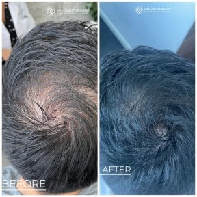 Before and after stem cell hair treatment result at Immunotherapy Regenerative Medicine clinic