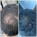 Before and after stem cell hair treatment result at Immunotherapy Regenerative Medicine clinic