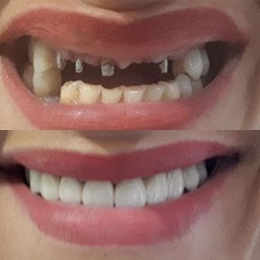 Before and after All-on-4 dental implants result at Hospitadent Dental Group - Alanya Clinic