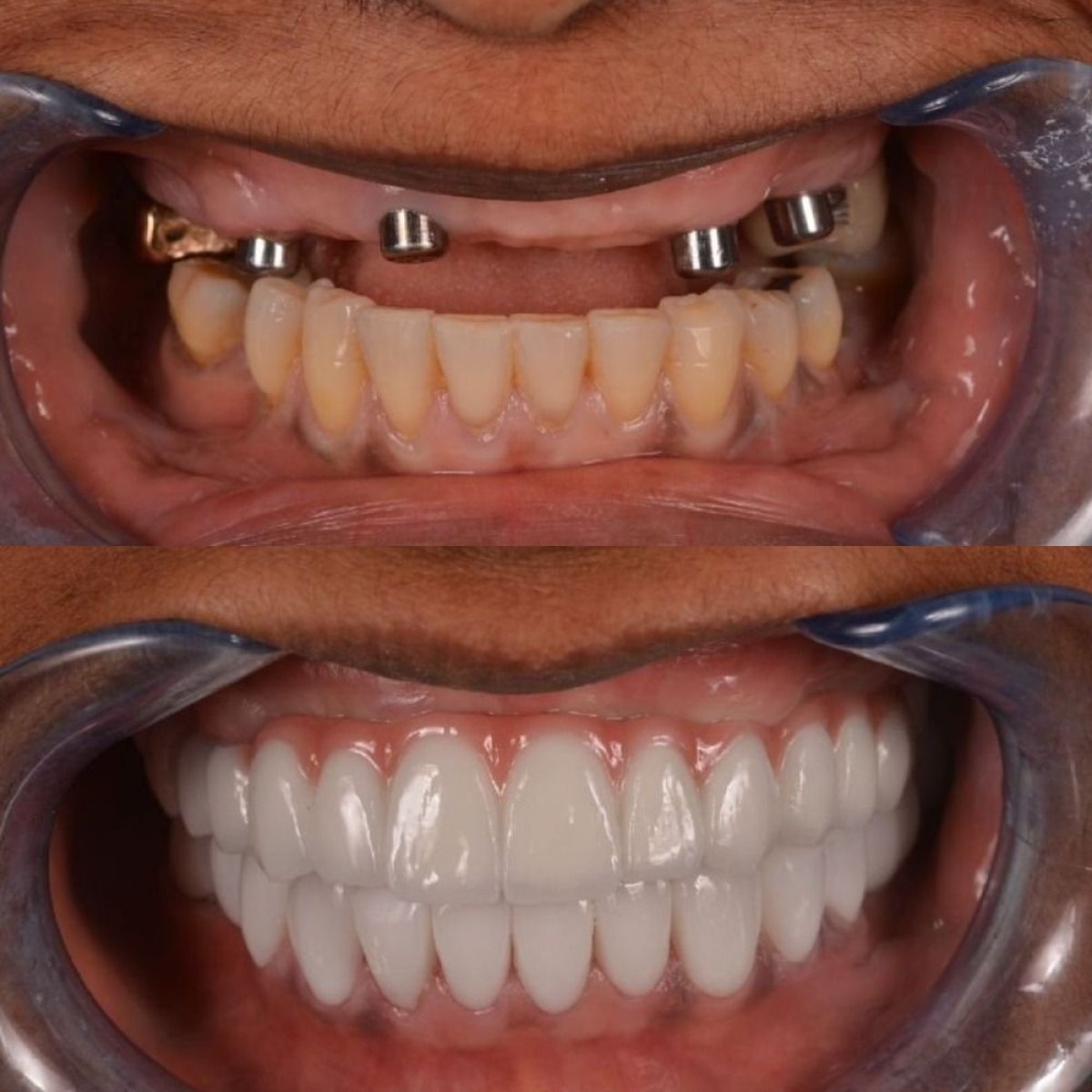 نتيجة قبل وبعد زراعة الأسنان All-on-4 في Hospitadent Dental Group - Alanya Clinic
