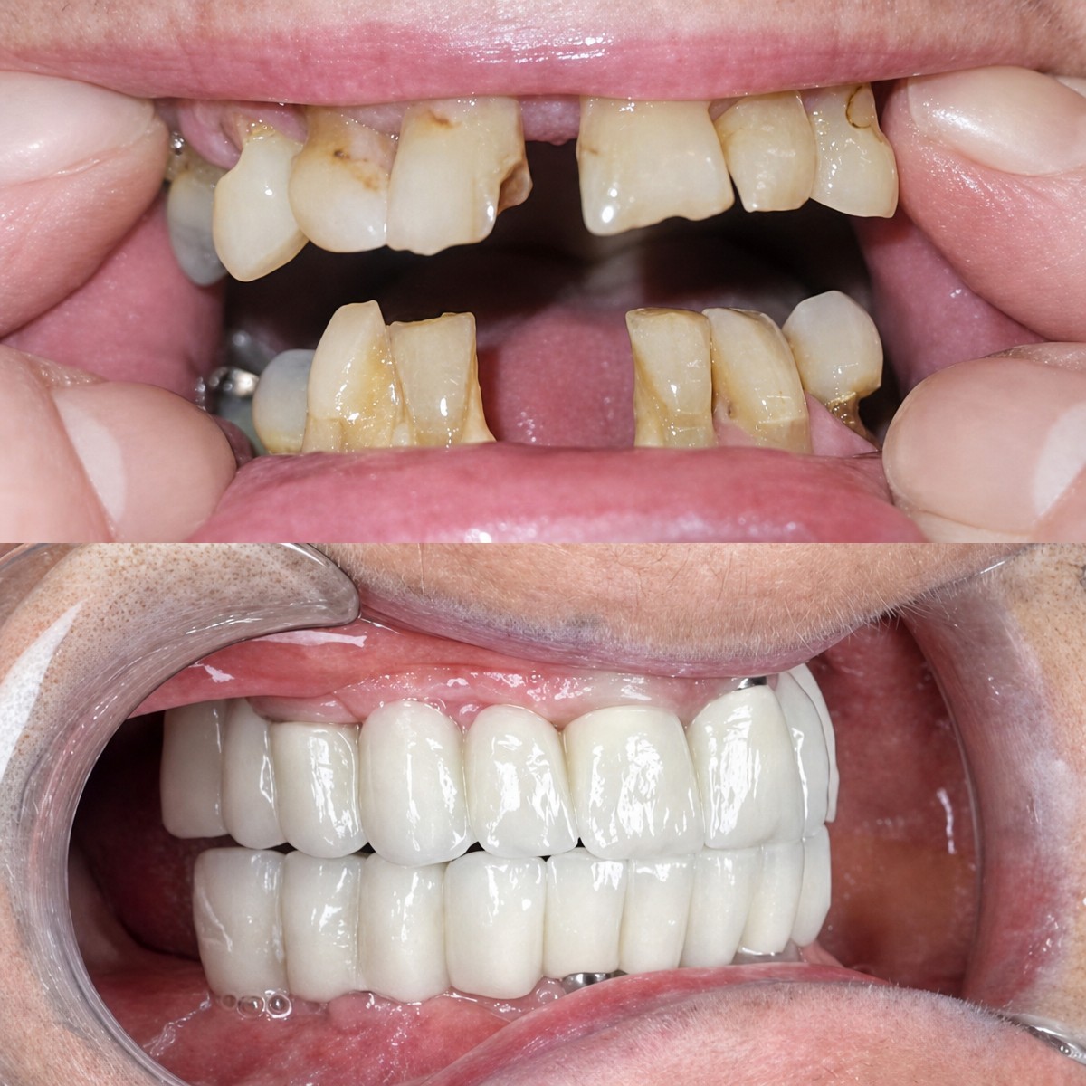 نتيجة قبل وبعد زراعة الأسنان All-on-4 في Hospitadent Dental Group - Alanya Clinic