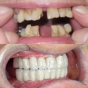 Before and after All-on-4 dental implants result at Hospitadent Dental Group - Alanya Clinic