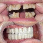 Before and after All-on-4 dental implants result at Hospitadent Dental Group - Alanya Clinic