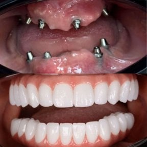Before and after All-on-4 dental implants result at Hospitadent Dental Group - Alanya Clinic
