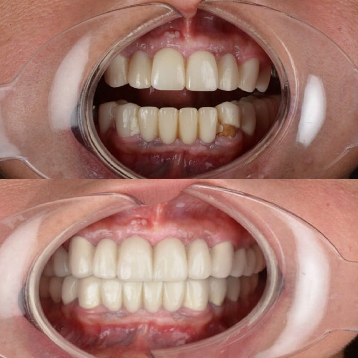 Resultados antes y después de coronas dentales en Hospitadent Dental Group - Alanya Clinic