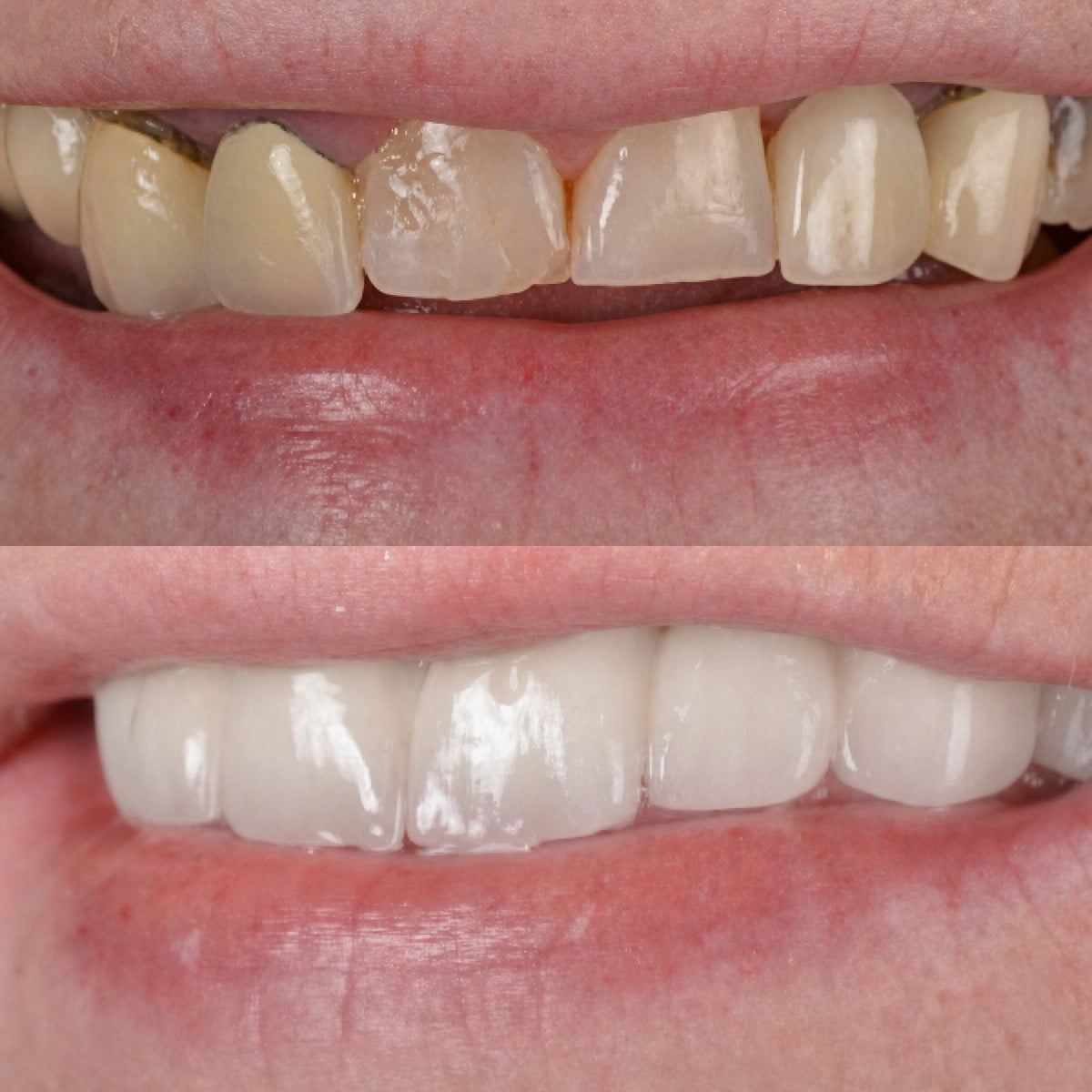 Resultados antes y después de coronas dentales en Hospitadent Dental Group - Alanya Clinic