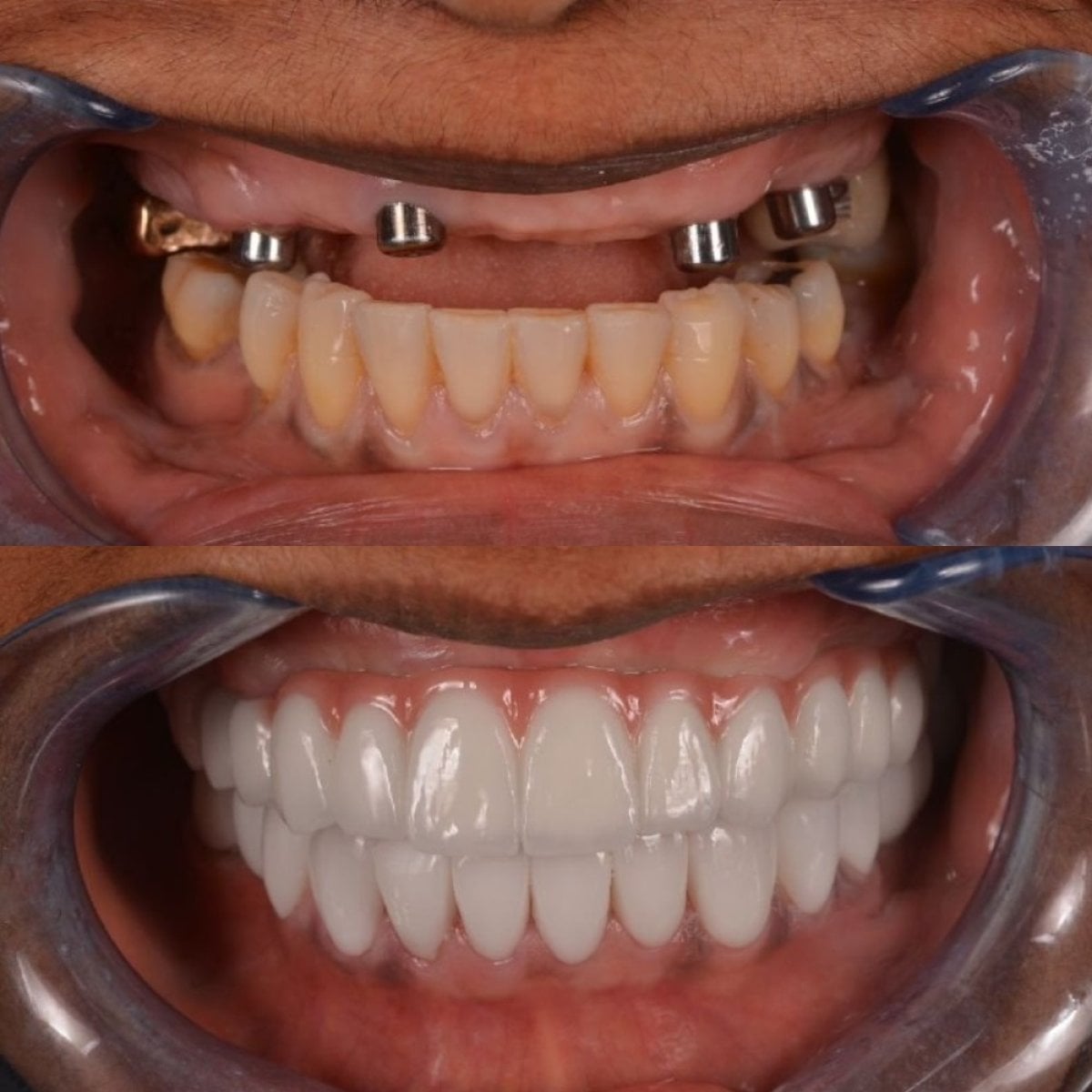 نتيجة قبل وبعد زراعة الأسنان All-on-6 في Hospitadent Dental Group - Alanya Clinic