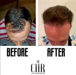Before and after FUE hair transplant results at Cancun Hair Restoration, improved hairline