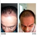 Before and after FUE hair transplant results at Cancun Hair Restoration, improved hairline