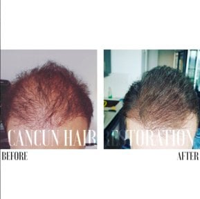 Before and after FUE hair transplant results at Cancun Hair Restoration, improved hair density