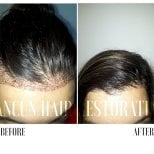 Before and after FUE hair transplant results at Cancun Hair Restoration, improved hairline