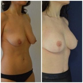 Before and after breast implants with lift results at Istanbul Aesthetic Plastic Surgery Center