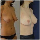 Before and after breast implants with lift results at Istanbul Aesthetic Plastic Surgery Center