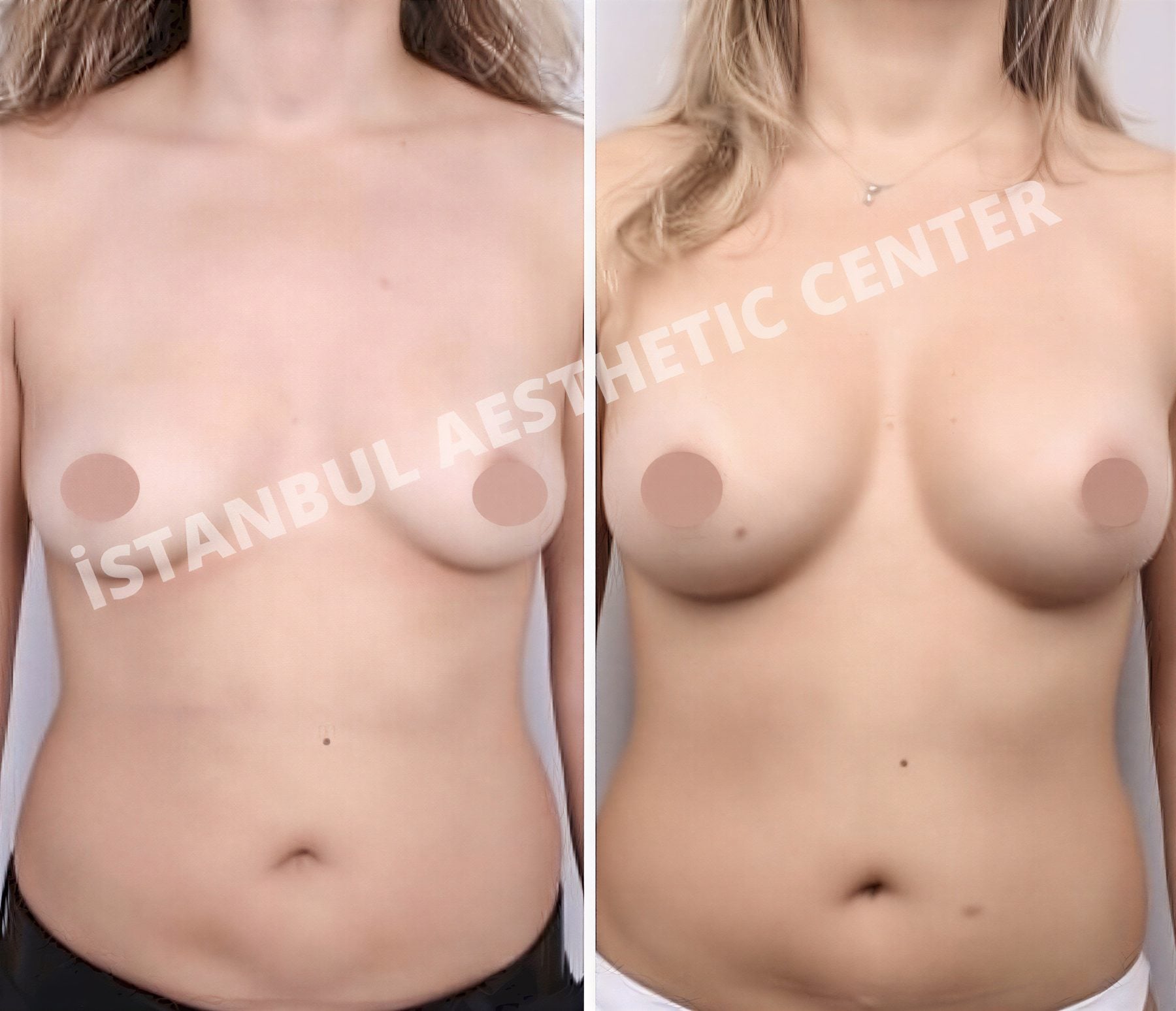 Resultados antes y después de implantes y levantamiento de senos en Istanbul Aesthetic Plastic Surgery Center