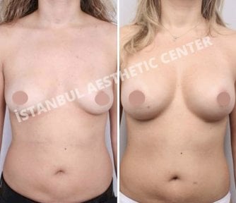 Before and after breast implants with lift results at Istanbul Aesthetic Plastic Surgery Center
