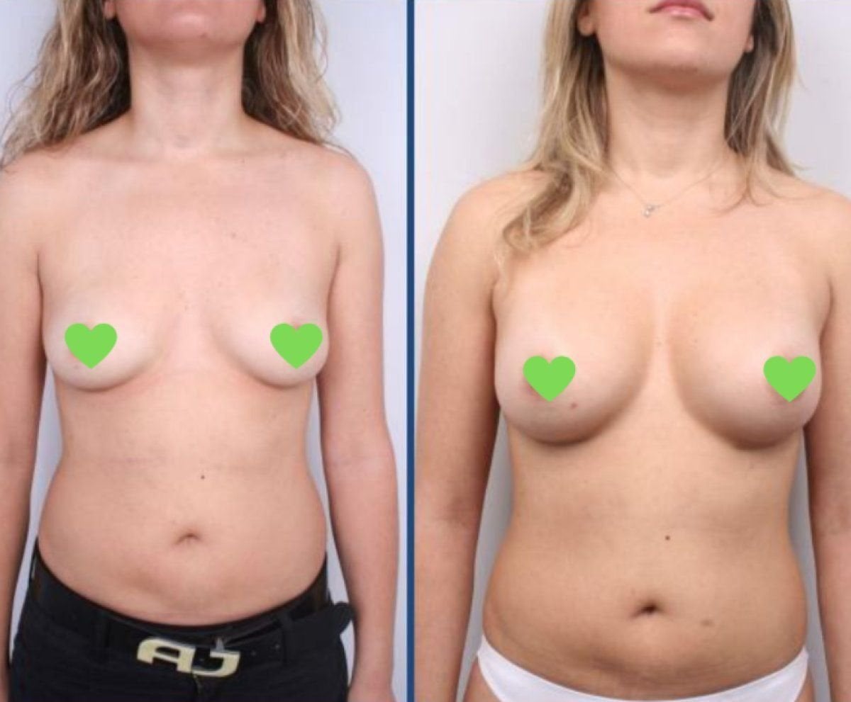 Resultados antes y después de implantes y levantamiento de senos en Istanbul Aesthetic Plastic Surgery Center
