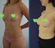 Before and after breast implants with lift results at Istanbul Aesthetic Plastic Surgery Center