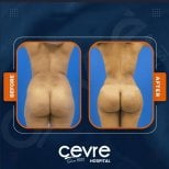 Resultados antes y después de Brazilian Butt Lift en Adem and Havva Medical Center, mejor contorno