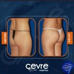 Resultados antes y después de Brazilian Butt Lift en Adem and Havva Medical Center, curvas mejoradas