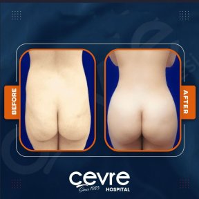 Vorher-nachher-Ergebnisse Brazilian Butt Lift bei Adem and Havva Medical Center, verbesserte Form