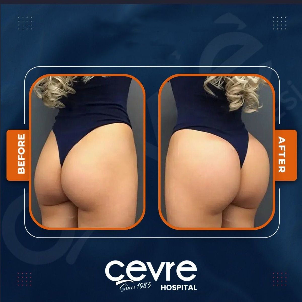 Resultados antes y después de Brazilian Butt Lift en Adem and Havva Medical Center, curvas mejoradas