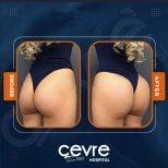 Resultados antes y después de Brazilian Butt Lift en Adem and Havva Medical Center, curvas mejoradas