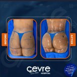 Vorher-nachher-Ergebnis Brazilian Butt Lift bei Cevre Hospital, verbesserte Gesäßform