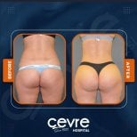 Resultados antes y después de Brazilian Butt Lift en Adem and Havva Medical Center, mejor contorno