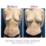 Foto prima e dopo di Aumento del seno con protesi in silicone realizzate dal Dott./Dott.ssa 