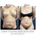 Foto prima e dopo di Aumento del seno con protesi in silicone realizzate dal Dott./Dott.ssa 