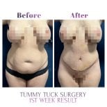 Foto prima e dopo di Aumento del seno con protesi in silicone realizzate dal Dott./Dott.ssa 