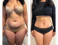 360 liposuction before and after results at Dr. Safa Manav Clinic, body contour improvement