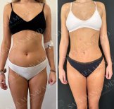 360 liposuction before and after results at Dr. Safa Manav Clinic, visible body contouring