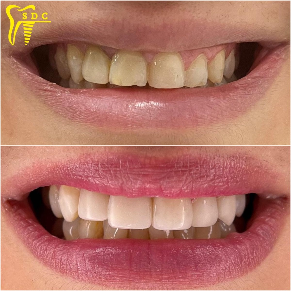 Resultado antes y después de carillas en Spanderashvili Dental Clinic, transformación visible de la sonrisa