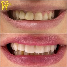 Before and after veneers result at Spanderashvili Dental Clinic, smile transformation visible
