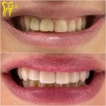 Before and after veneers result at Spanderashvili Dental Clinic, smile transformation visible